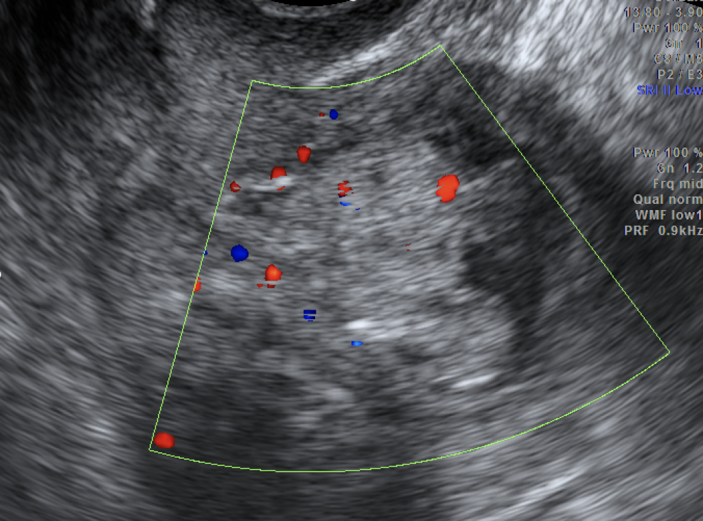 Ecografia Transvaginale Come Funziona E Perch Importante