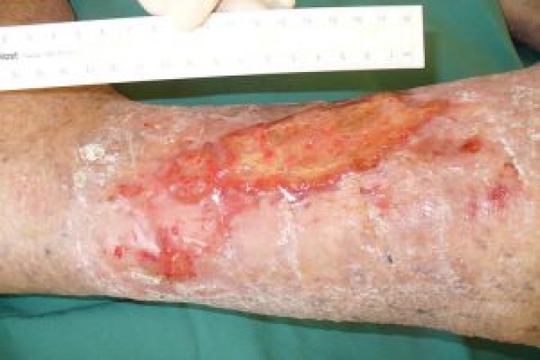 Wound Care Guideline Part Leg Ulceration Dressing