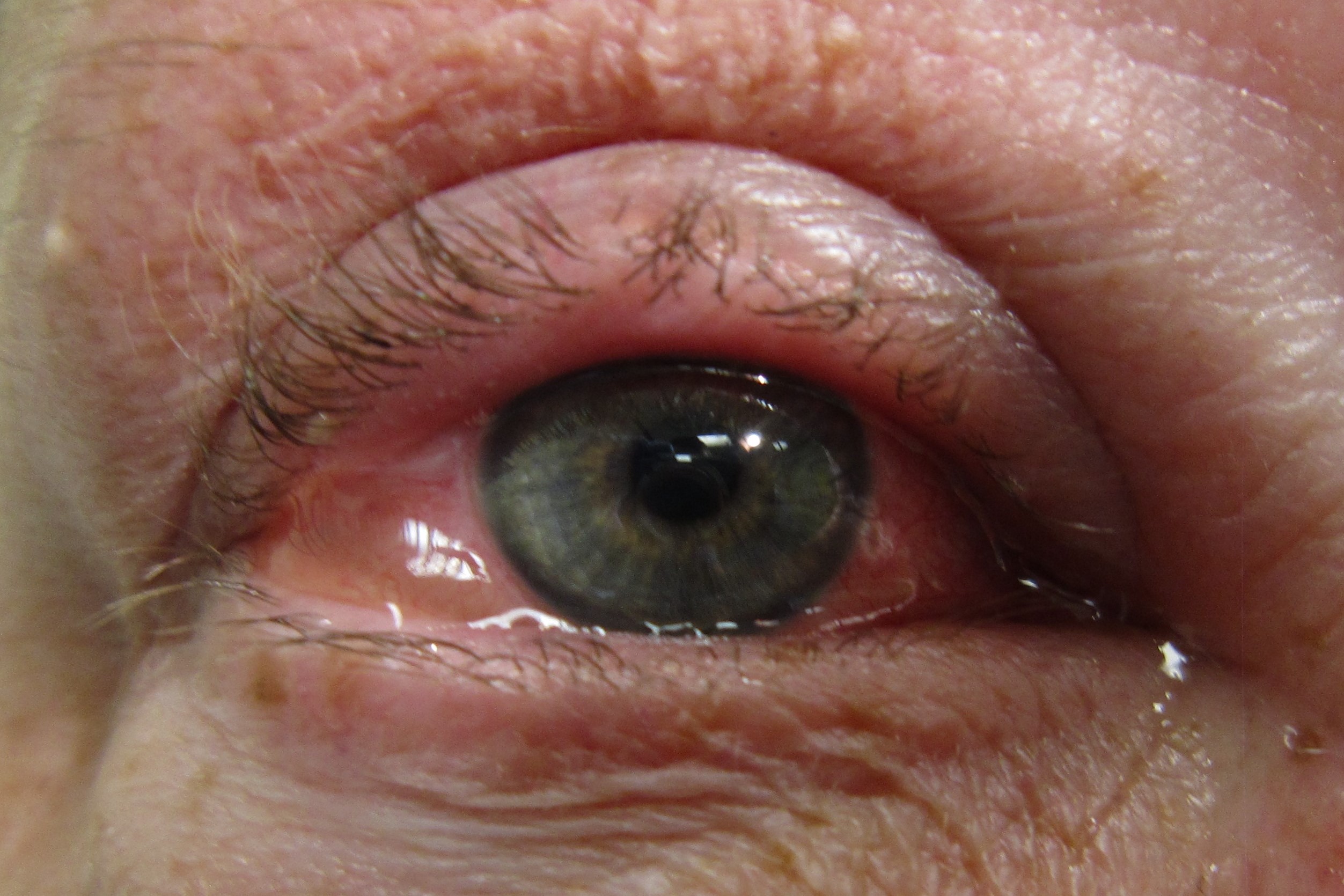 Allergische Conjunctivitis Oorzaken Symptomen En Preventie Live 