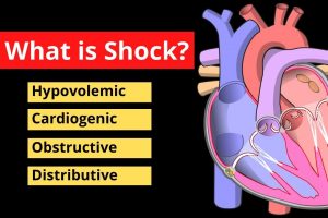 Differences between compensated, decompensated and irreversible shock