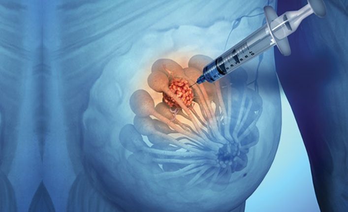 AAPA Students on X: When a breast biopsy is performed, a metallic biopsy  clip is placed where the biopsy was taken. Later, the same location of the  biopsy can be found by