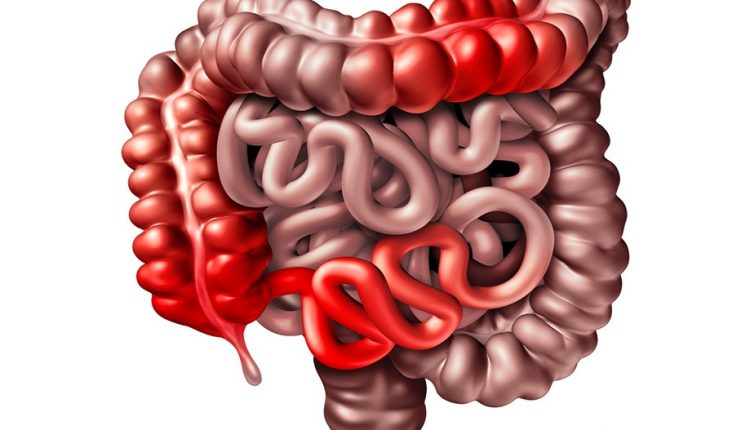 Enfermedades Inflamatorias Crónicas Del Intestino: ¿qué Son?