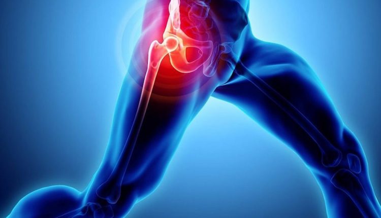 Snapping hip syndrome: what it is and how to treat it